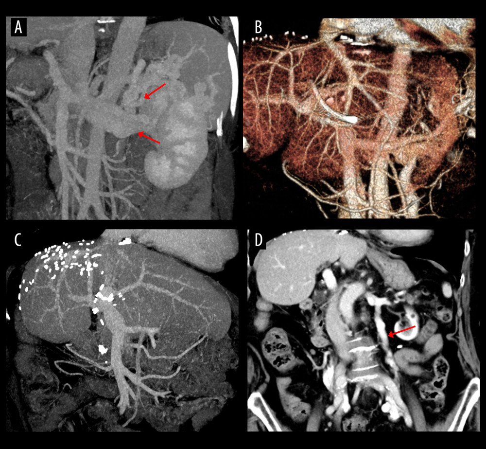 Computed tomography (CT) scans showing resolution of the spontaneous splenorenal shunt (SSRS) after left renal vein ligation. (A) Large SSRS branches (arrows) were identified at the pre-transplant CT. (B) SSRS disappeared at CT scan taken 3 months after transplantation. (C, D) Follow-up CT scans taken 21 years after transplantation showed absence of SSRS with left renal vein outflow drainage through the enlarged left gonadal vein (arrow).