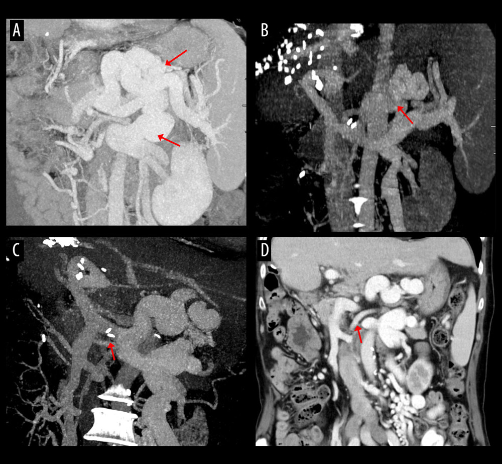 Computed tomography (CT) scans showing persistence of spontaneous splenorenal shunt (SSRS) after left renal vein ligation. (A) Large SSRS branches (arrows) were identified at the pre-transplant CT. (B) Some SSRS branches (arrow) were persistently identified at CT scan taken 6 months after transplantation. (C, D) Follow-up CT scans taken 20 years after transplantation showed persistence of SSRS with the ligated stump of the proximal left renal vein (arrows).