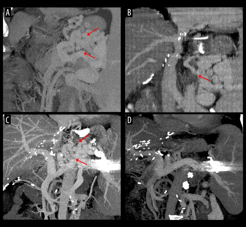 Computed tomography (CT) scans showing interventional occlusion of the spontaneous splenorenal shunt (SSRS) through retrograde transvenous obliteration. (A) Large SSRS branches (arrows) were identified at the pre-transplant CT. (B) Small SSRS branches (arrow) were identified at CT scan taken 1 year after transplantation. (C) Large SSRS branches (arrows) were identified at CT scan taken 7 years after transplantation with reopening of the left renal vein. (D) Follow-up CT scan taken 9 years after transplantation (1 year after retrograde transvenous obliteration) showed disappearance of SSRS.