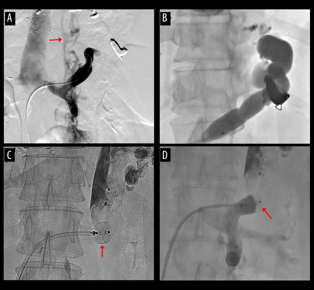 Procedures of plug-assisted retrograde transvenous obliteration (PARTO). (A) Retrograde venography shows development of the spontaneous splenorenal shunt (SSRS) with esophageal varices (arrow). (B, C) Distal branches are embolized and the large SSRS was occluded with a vascular plug (arrow). (D) The SSRS was completely occluded after PARTO (arrow).