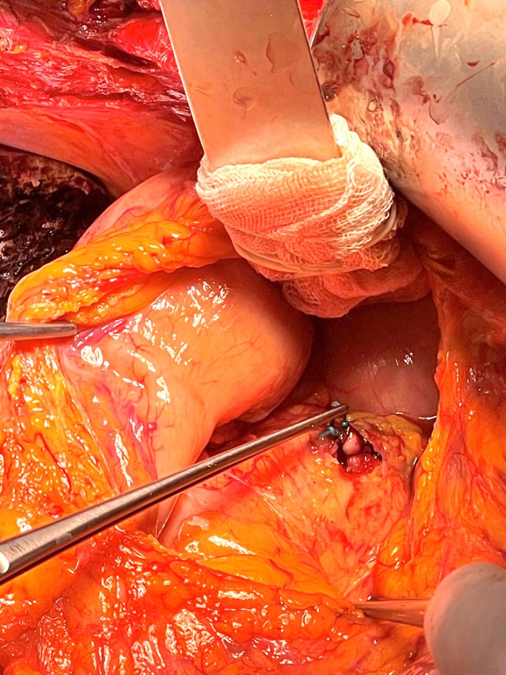 Intraoperative image of splenic artery ligation.