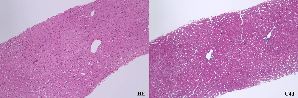 Liver biopsy in case 3 shows no evidence of rejection or graft fibrosis at 1 and 2 years after immunosuppression withdrawal.