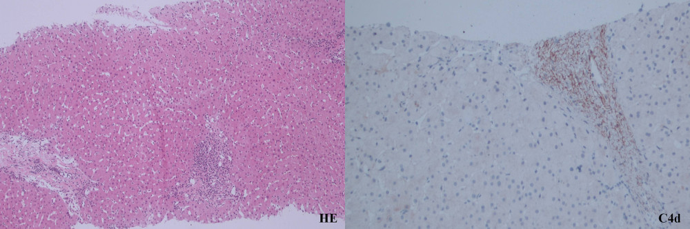 Liver biopsy in case 1 at 3 years after immunosuppression withdrawal shows a borderline rejection with stromal C4d positivity.