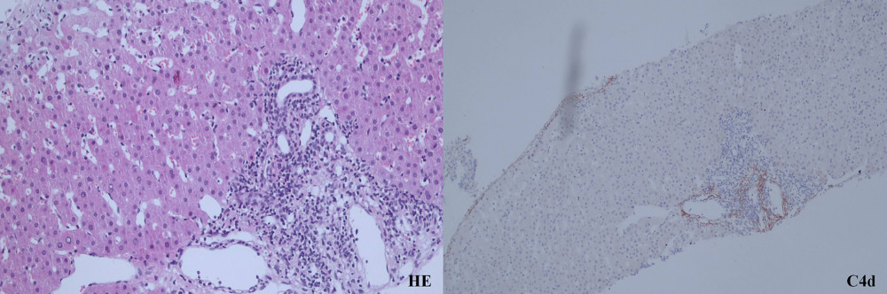 Liver biopsy shows mild rejection (Banff score=4) and C4d positivity in case 6 at 4 months after immunosuppression withdrawal.