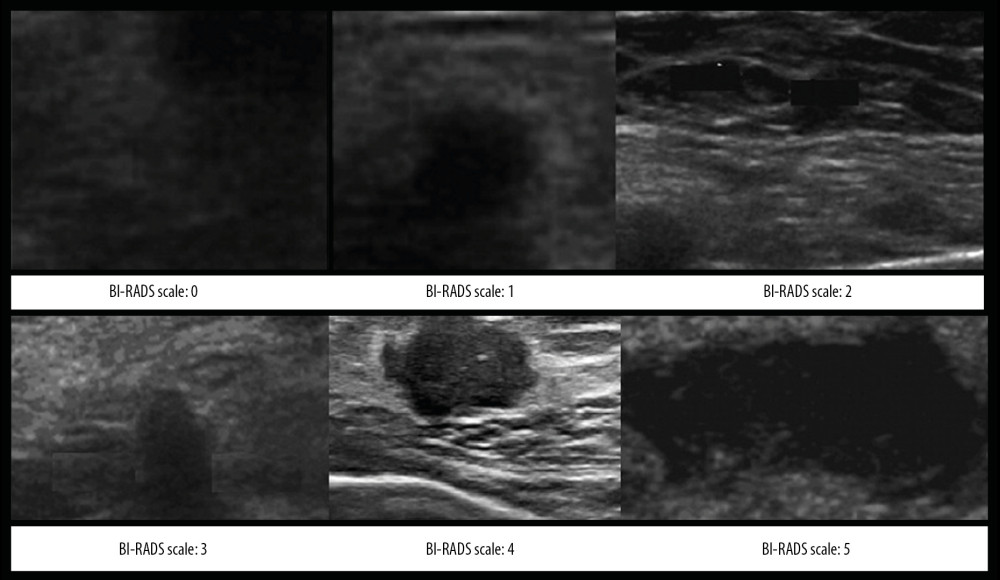 The Breast Imaging-Reporting and Data System (BI-RADS) scores according to the breast ultrasound.