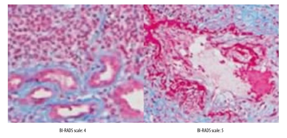 The Breast Imaging-Reporting and Data System (BI-RADS) scores according to the histopathology of the breast biopsies.