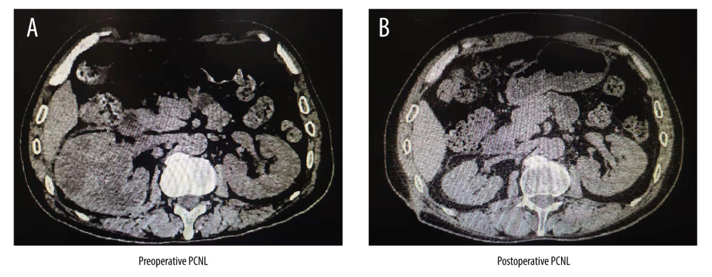 An example image of atrophied kidney after PCNL before/after surgery. A is a renal CT scan of a patient with pyonephrosis before PCNL. B is a renal CT scan of a patient with pyonephrosis after PCNL.