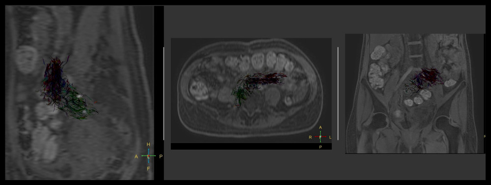 Diffusion tensor imaging (DTI) reconstruction of transplanted pancreas superimposed on DTI b0; sagittal, axial, and coronal images.