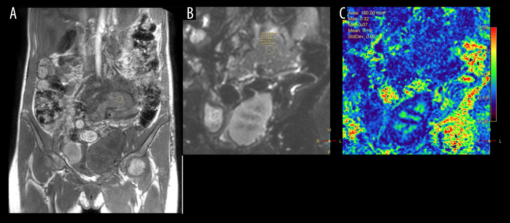 T1W (A), diffusion tensor imaging (DTI) b0 (B), and DTI fractional anisotropy map (C). DTI measures in the head of the transplanted pancreas ranged from 0.07 to 0.32, with a mean value of 0.19.