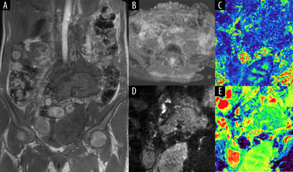 (A) Dixon T1-weighted image, coronal section. (B) Apparent diffusion coefficient map from isotropic diffusion-weighted images, axial section. (C) Fractional anisotropy map from diffusion tensor imaging (DTI), coronal section. (D) Isotropic diffusion image from DTI, b value 800, coronal section. (E) Apparent diffusion coefficient map from DTI, coronal section.