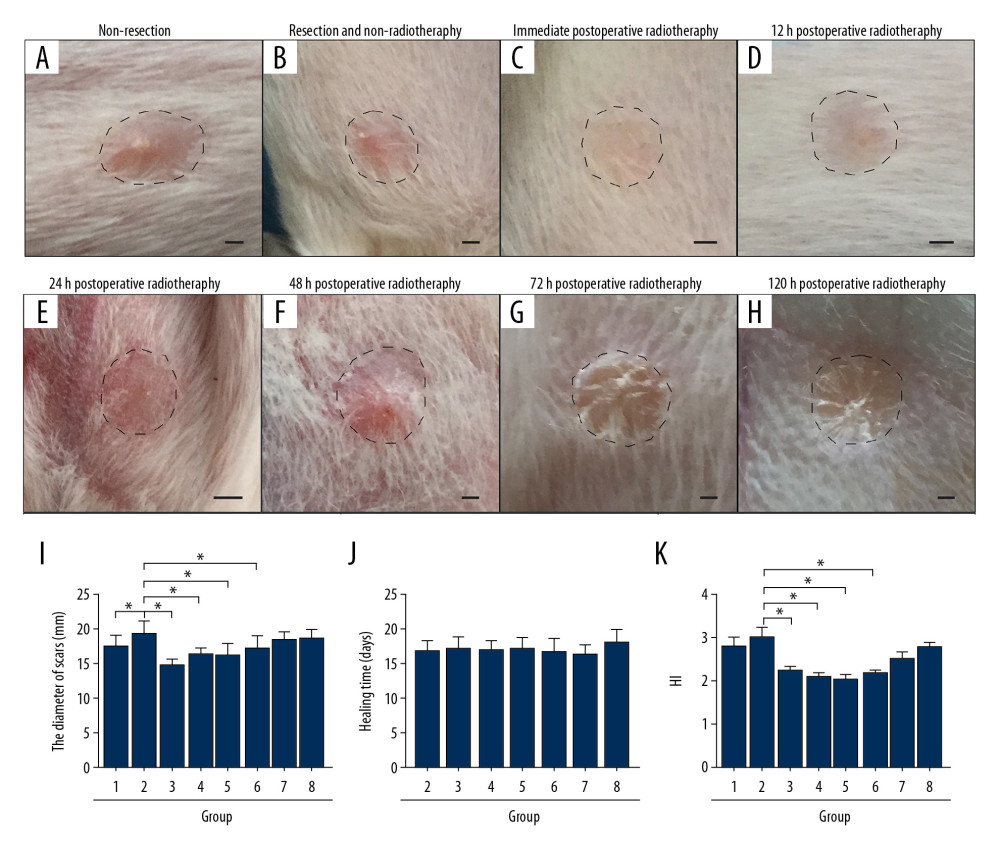 In the rabbit model, early radiotherapy significantly reduced the severity of the hypertrophic scar. (A) The non-resection group, without surgery and radiotherapy, shows the visible convex surface of the hypertrophic scar at 30 days after surgery. (B) The resection and radiotherapy group shows the visible convex surface of the hypertrophic scar. (C–F) In the early postoperative radiotherapy groups, the hypertrophic scar surface was flat, and the skin color was normal. (G, H) In the late postoperative radiotherapy groups, a convex hypertrophic scar remained. (I) Quantification of the diameter of the hypertrophic scar. (J) Quantification of the healing time of the hypertrophic scar. (K) Quantification of the hypertrophic scar index (HI). Group 1, the non-resection group. Group 2, the resection and non-radiotherapy group. Group 3, the immediate postoperative radiotherapy group. Group 4, the 12-hour postoperative radiotherapy group. Group 5, the 24-hour postoperative radiotherapy group. Group 6, the 48-hour postoperative radiotherapy group. Group 7, the 72-hour postoperative radiotherapy group. Group 8, the 120-hour postoperative radiotherapy group. Scale bar = 50 μm.