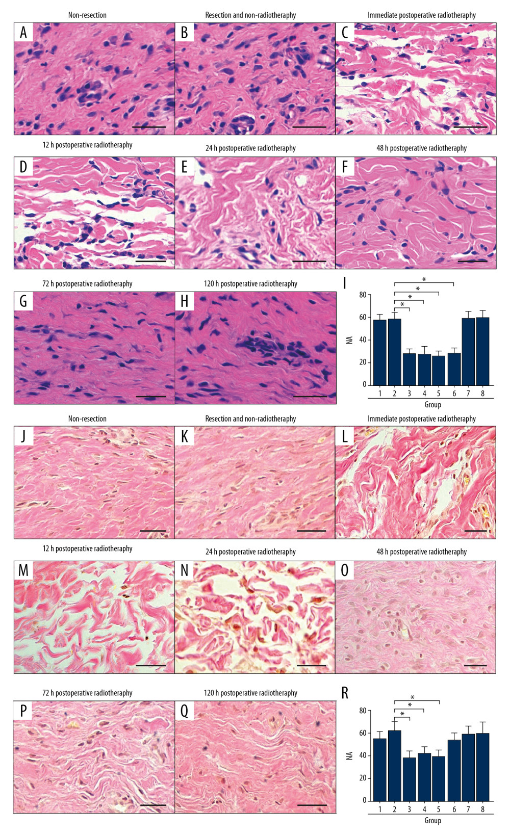 (A–R) In the rabbit model, early radiotherapy significantly reduced the number of fibroblasts in hypertrophic scar. (A, B) The non-resection group and the resection and non-radiotherapy group showed a large number of fibroblasts in the hypertrophic scar. (C–F) In the early postoperative radiotherapy groups, fibroblasts were significantly reduced. (G, H) The late postoperative radiotherapy groups showed a large number of fibroblasts. (I) The quantification of fibroblast numerical area density (NA). (J, K) In the non-resection group and the resection and non-radiotherapy group, a large number of dense collagen fibers can be seen. (O–Q) Collagen fibers were denser in the late postoperative radiotherapy groups than in the early postoperative radiotherapy groups, except the 48-hour postoperative radiotherapy group. (R) The quantification of collagen fiber area density (AA). Scale bar=50 μm.