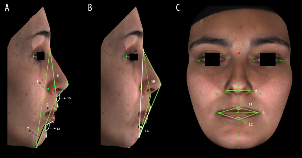 (A–C) Three-dimensional photogrammetric measurements: (A) 1. Anterior Facial Height (mm). 2. Lower Anterior Facial Height (mm). 4. Upper Lip Length (mm). 5. Lower Lip Length (mm). 7. Chin Height (mm). 8. Nose Height (mm). 13. Labiomental Angle (°). 15. Nasolabial Angle (°). (B) 9. Soft Tissue Convexity Angle (°). 10. Total Facial Convexity Angle (°). 14. H Angle (°). (C) 3. Lip Width (mm). 6. Nose Width (mm). 11. Upper Lip Angle (°). 12. Lower Lip Angle (°) (All the parameters are defined in Table 3).
