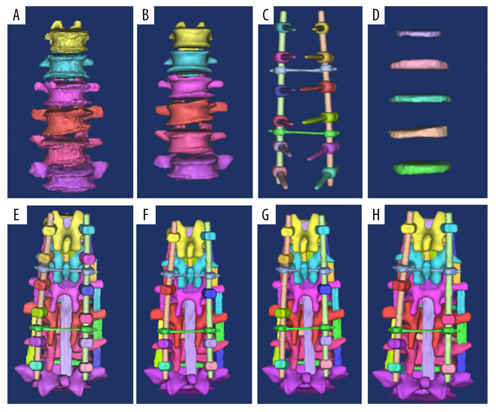 Reconstruction of postoperative spinal model of ADS patient with Mimics17.0. (A) Primary 3D vertebral body model by Mimics17.0 software. (B) Final 3D vertebral body model by the Mimics’ Remesh function. (C) Establishment of 3D screw-rod system. (D) Establishment of a 3D model of lumbar intervertebral discs. (E–H). Primary full-segment (E), interval (F), key vertebra (G) and strategic (H) screw models.
