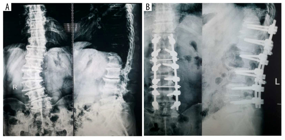 The X-ray images of spine (T12–L5) before (A) and after (B) operation.