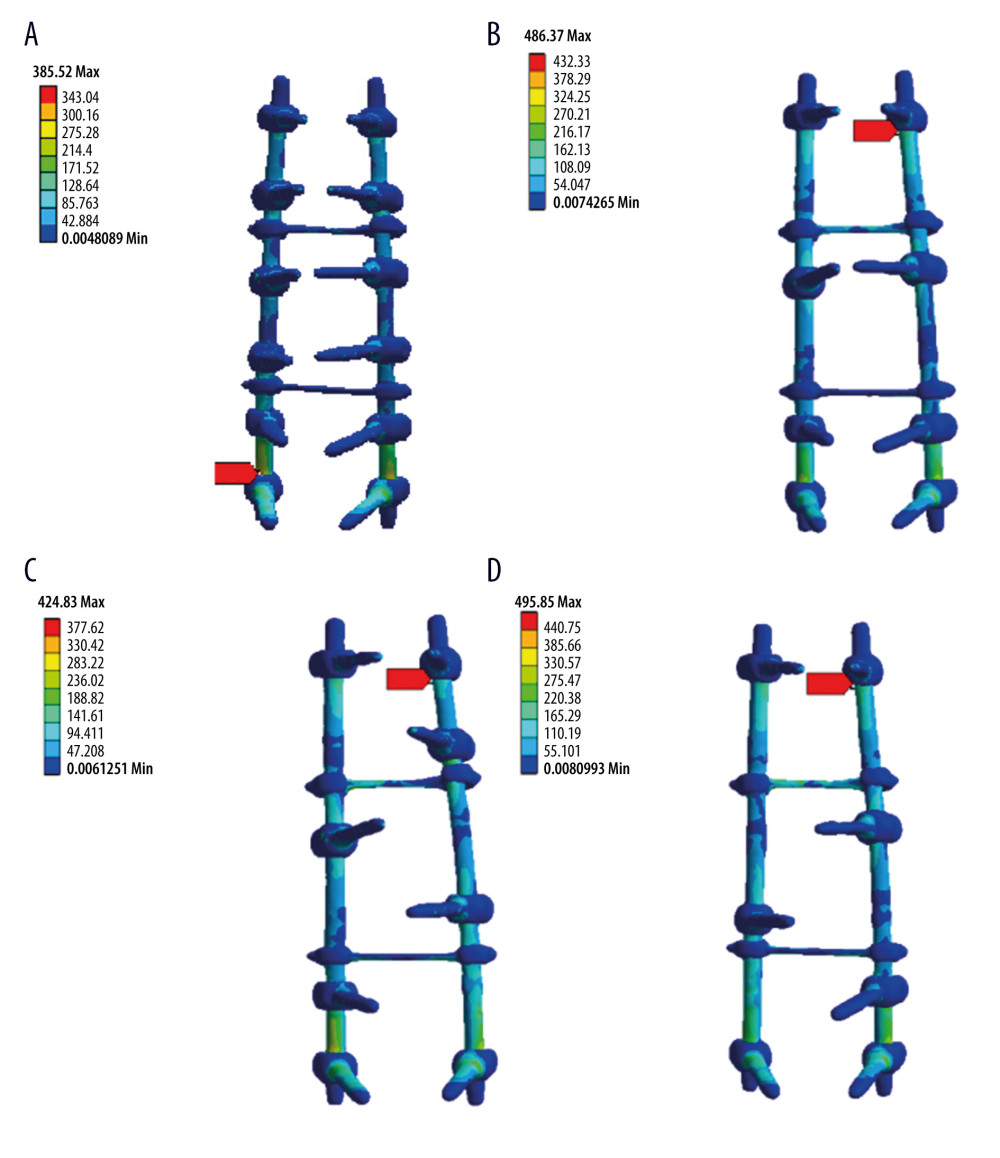 Typical biomechanical characteristics of the screw-rod systems of the full-segment (A), interval (B), key vertebra (C), and strategic (D) screw systems under left lateral flexion condition.