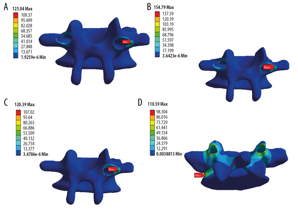 Typical biomechanical characteristics of the intervertebral discs of the full-segment (A, L2), interval (B, L2), key vertebra (C, L2), and strategic (D, L5) screw systems under left lateral flexion condition.