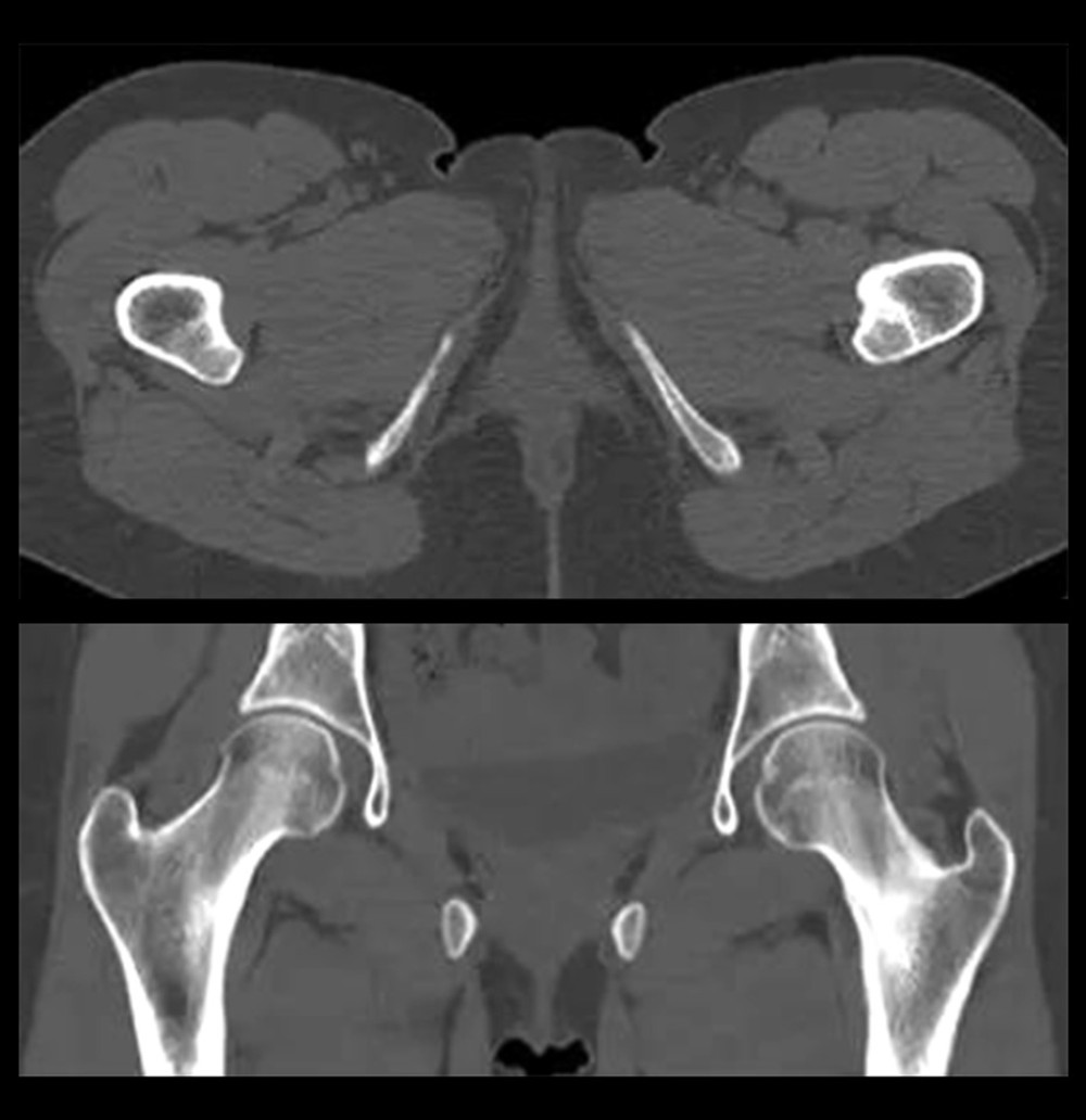 Computed tomography (CT) scan: Cortical tissue of the left femoral neck.