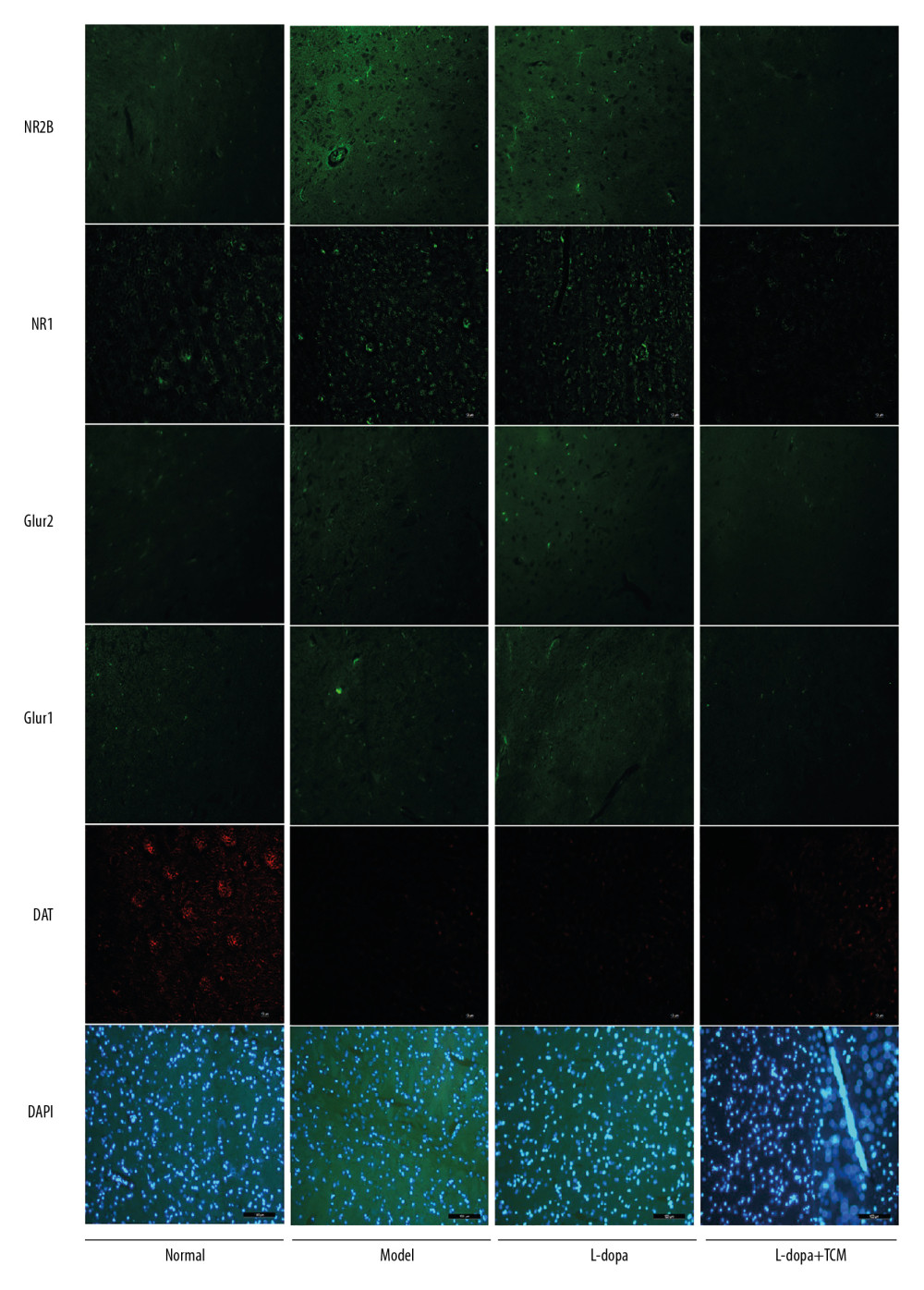 Immunofluorescence pictures showed that levodopa combined with Bushen Zhichan recipe protected the DAT cells and reduced the expressions of excitatory amino acid receptors. The scale of the pictures is 100 microns, and the magnification is 400 times.