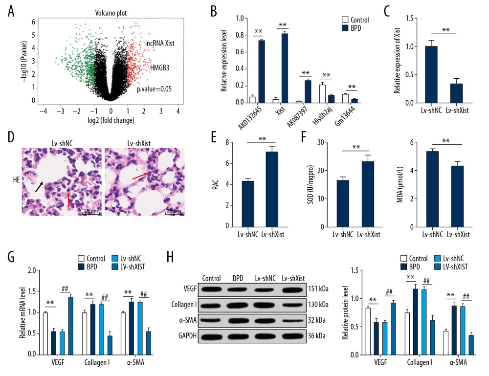 Silenced Xist alleviated lung damage in newborn BPD mice. (A) There was a significantly different fold change in lncRNA expressions between the control group and the BPD group. (B) RT-qPCR showed that the Xist expression was clearly higher in BPD mice than in control mice, n=3. (C) RT-qPCR showed that Xist expression in BPD group was evidently lower than that in the control group with silenced Xist, n=3. (D) HE staining suggested that the lung tissue structure in BPD mice was improved when Xist expression was silenced, with the black arrows indicating alveolar fusion and the red ones indicating alveolar septum, ×400, n=5. (E) RAC in BPD mice increased with silenced Xist, n=5. (F) ELISA showed that SOD activity was increased while MDA level was decreased in BPD mice with silenced Xist, n=3. (G, H) RT-qPCR and Western blot analysis showed that VEGF mRNA and protein expression levels were reduced while mRNA and protein expression levels of collagen I and α-SMA were increased, n=3. Two-way ANOVA was applied to assess data in panels B, G, and H. Tukey’s multiple comparisons test was used for post hoc test. The t test was used for analyzing data in remaining panels. ** p<0.01, ## p<0.01. Xist – X inactive specific transcript; BPD – bronchopulmonary dysplasia; RT-qPCR – reverse transcription-quantitative polymerase chain reaction; HE – hematoxylin-eosin; RAC – radial alveolar counts; SOD – superoxide dismutase; MDA – malondialdehyde; VEGF – vascular endothelial growth factor; α-SMA – alpha-smooth muscle Actin; ANOVA – analysis of variance.