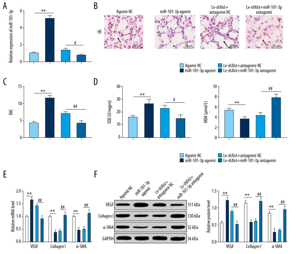 Overexpressed miR-101-3p mitigated lung damage in newborn BPD mice. (A) RT-qPCR showed silencing miR-101-3p in lung tissues reduced miR-101-3p expression in BPD mice, n=3. (B) HE staining indicated the structural changes in lung tissues of BPD mice after silencing miR-101-3p, with the black arrows indicating alveolar fusion and the red ones indicating alveolar septum, ×400, n=5. (C) RAC was enhanced when miR-101-3p was overexpressed, n=5. (D) ELISA showed improved SOD activity and decreased MDA level with overexpressed miR-101-3p, n=3. (E, F) RT-qPCR and Western blot analysis suggested that mRNA expression and protein level in VEGF were enhanced while those in collagen I and α-SMA were reduced, n=3. Two-way ANOVA was applied to assess data in panels E, F, and one-way ANOVA was applied to assess data in panels A, C, and D. Tukey’s multiple comparisons test was applied for post hoc test. The t test was used for analyzing data in remaining panels. ** p<0.01, ## p<0.01. miR – microRNA; BPD – bronchopulmonary dysplasia; RT-qPCR – reverse transcription-quantitative polymerase chain reaction; HE – hematoxylin-eosin; RAC – radial alveolar counts; SOD – superoxide dismutase; MDA – malondialdehyde; VEGF – vascular endothelial growth factor; α-SMA – alpha-smooth muscle Actin; ANOVA – analysis of variance.