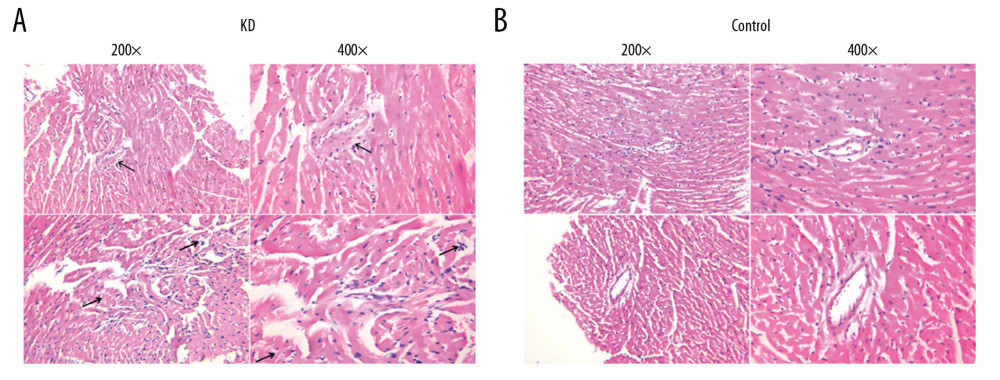 Pathological features of the coronary artery root in KD (A) and control (B) groups. The root of the coronary artery obtained from the KD vasculitis mice exhibited accumulation of foam cells and inflammatory cell infiltration, which were accompanied by dissolved and necrotic CASMCs, as arrows pointing to the positions. These pathological phenotypes were not present in the coronary artery of the control mice.