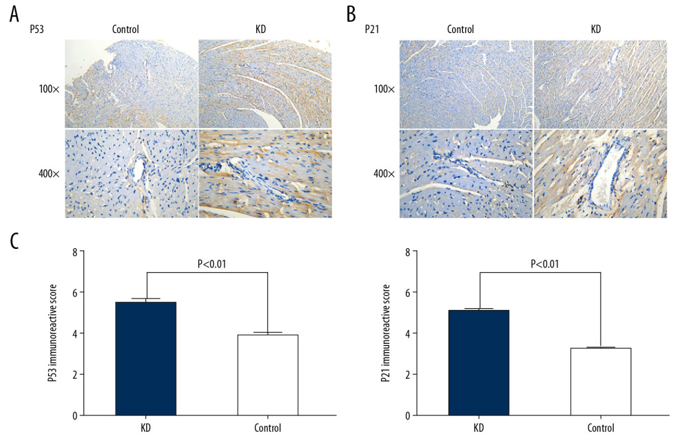 Comparison of p53 (A, C) and p21 (B, C) IRS values between the KD (n=12) and control groups (n=12). Cytoplasmic staining of p53 in CASMCs was moderate and strong in the mice of the KD group, whereas only mild or no staining was observed in mice of the control group (A). Cytoplasmic staining for p21 in CASMCs was moderate and strong in mice of the KD group, but mild or absent in mice of the control group (B). The IRS values for p53 and p21 were significantly different between the KD group and control group (C).