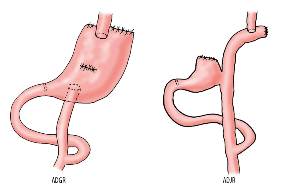 The surgical diagram of antrum-preserving double tract gastric interposition reconstruction (ADGR) and antrum-preserving double tract jejunal interposition reconstruction (ADJR).