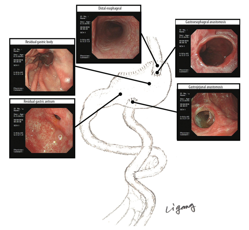 The gastroscopic diagram of antrum-preserving double tract gastric interposition reconstruction (ADGR).