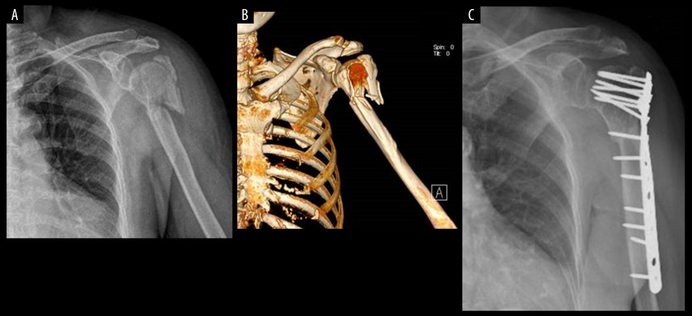 (A) Representative anteroposterior plain radiograph showing proximal humeral fractures involving the humeral shaft. (B) 3D CT showing proximal humeral fractures involving the humeral shaft. (C) Postoperative anteroposterior plain radiograph showing fracture fixation with a long locking plate.