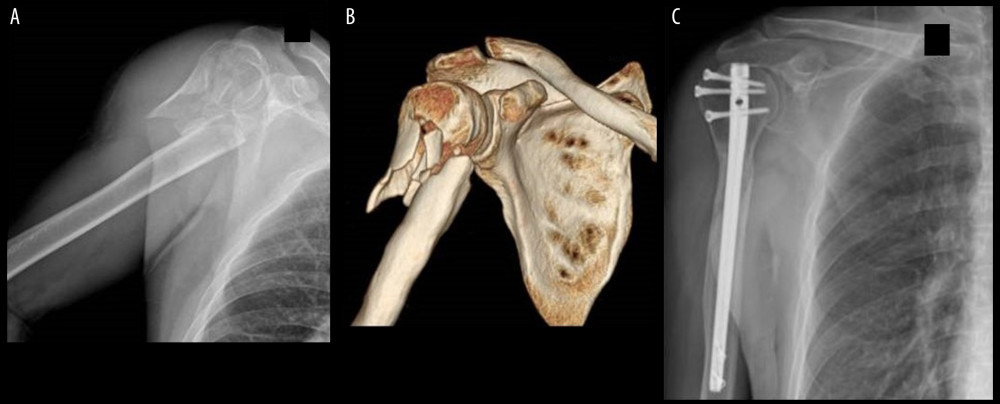 (A) Representative anteroposterior plain radiograph showing proximal humeral fractures involving the humeral shaft. (B) 3D CT showing proximal humeral fractures involving the humeral shaft. (C) Postoperative anteroposterior plain radiograph showing fracture fixation with a long locking intramedullary nail.