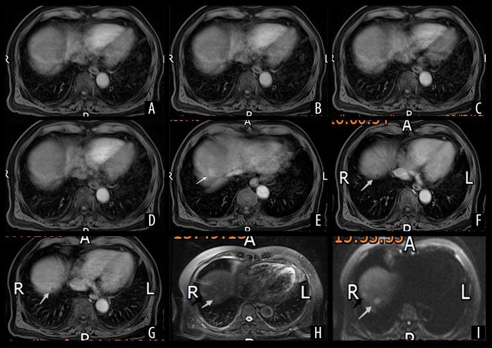 Multi-Arterial CAIPIRINHA-Dixon-TWIST–Volume-Interpolated Breath-Hold Examination (MA-CDT-VIBE) of a 73-year-old male patient with a history of chronic hepatitis B virus (HBV) infection for more than ten years and ultrasound diagnosis of liver cirrhosis Two round nodules are shown in the right posterior lobe (VII) (black and white arrows). Panel A–E show the first, second, third, fourth, and fifth arterial subphases of the MA-CDT-VIBE sequence, respectively. Panel D (fourth arterial subphase) is an equivalent standard arterial phase (ESAP) image. Panel F is a portal vein phase image. Panel G is a delayed phase image. Panel H is an image obtained by T2-weighted imaging (T2WI). Panel I is an image obtained by diffusion-weighted imaging (DWI) (b = 800). The images show that the two enhanced nodules were not clearly shown in the first through fourth subphases. However, significantly enhanced lesions were observed in the fifth arterial phase. White arrows indicate nodules with decreased signals in the portal vein phase (Panel F) and delayed phase (Panel G) exhibiting a ‘fast in and fast out’ type. The black arrows indicate nodules with a nonsignificant decrease in the signals in the portal vein phase and delayed phase. The two enhanced lesions show high signals on T2WI. The diffusion of the signals was limited on DWI (b=800), which shows high signals.