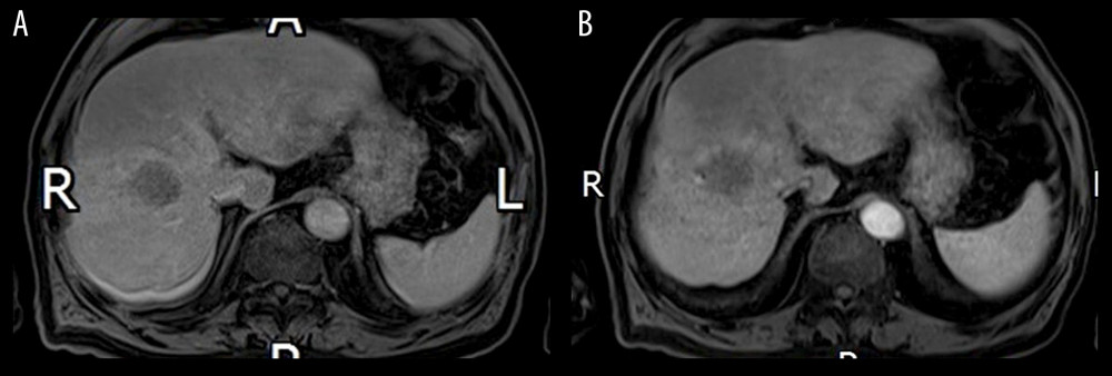 Multi-Arterial CAIPIRINHA-Dixon-TWIST–Volume-Interpolated Breath-Hold Examination (MA-CDT-VIBE) of a 71-year-old male approximately six months after microwave ablation of primary liver cancer. Panel A. Standard VIBE image. Panel B. Water image in the MA-CDT-VIBE image. As shown in Panel A and Panel B, the parallel acquired noise (PAT artifact) is mainly located in the right lobe of the liver. The granular noise in Panel b is more evident than that in Panel A. The PAT artifacts in Panel B do not affect the local structure display or the diagnosis of the lesions.