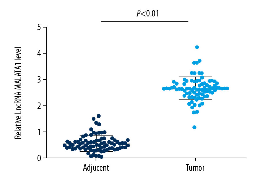 MALAT1 is upregulated in breast cancer tissues determined by qRT-PCR. Totally, 80 breast cancer patients were recruited. MALAT1 – metastasis-associated lung adenocarcinoma transcript 1; qRT-PCR – quantitative real-time polymerase chain reaction.