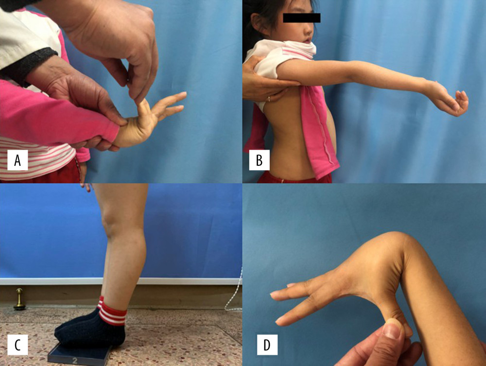 Clinical manifestations consistent with generalized joint laxity. (A) Passive hyperextension >90° of the fifth finger with the palm and wrist touching a solid surface. (B) Passive hyperextension >10° of the elbow with the upper limb extended and the palm turned up. (C) Passive hyperextension >10° of the knee while patient stands up. (D) Passive flexion of the thumb to touch the volar aspect of the forearm.
