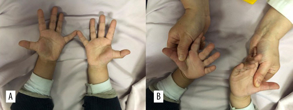 The relapsed case in metacarpophalangeal joint instability group after brace removal. (A) Interphalangeal joint could not be extended actively when metacarpophalangeal joint was in subluxation. (B) When metacarpophalangeal joint was reduced stabilized, interphalangeal joint could resume its extension function.