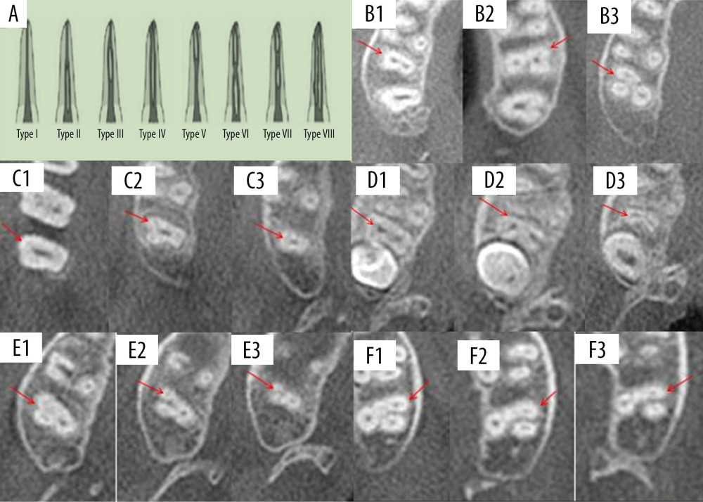 Schematic diagrams showing Vertucci’s classification of root canal morphology and canal configuration of permanent second molars of the upper jaw with fused roots. (A) Classification of the anatomic morphology of canals. (B) Teeth with one (B1), two (B2), and three (B3) roots. (C) Fused root with one root canal (C1, coronal 1/3; C2, middle 1/3; and C3, apical 1/3). (D) Fused root with two root canals (D1, coronal 1/3; D2, middle 1/3; D3, apical 1/3). (E) Fused root with three root canals (E1, coronal 1/3; E2, middle 1/3; E3, apical 1/3). (F) Fused root with four root canals (F1, coronal 1/3; F2, middle 1/3; F3, apical 1/3).