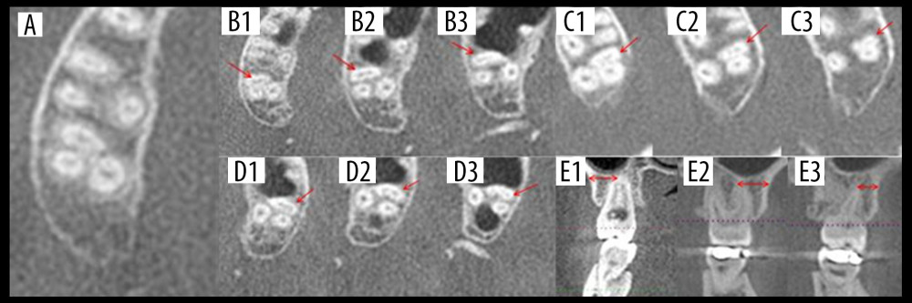 Types of canal configuration in mesiobuccal roots of permanent second molars of the upper jaw and horizontal distances from the buccal root apices to the surface of buccal cortical bone plate. (A) Type I. (B) Type II (B1, coronal 1/3; B2, middle 1/3; B3, apical 1/3). (C) Type III (C1, coronal 1/3; C2, middle 1/3; C3, apical 1/3). (D) Type IV (D1, coronal 1/3; D2, middle 1/3; D3, apical 1/3). (E) Horizontal distances from single buccal root (E1), mesiobuccal root (E2), and distobuccal root (E3) apices to the surface of the buccal cortical bone plate.