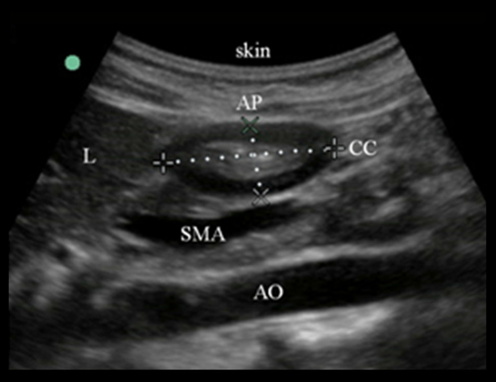 Measurement of the gastric antral area using transabdominal ultrasound. L – liver; AO – aorta; SMA – superior mesenteric artery; CC – cranio-caudal antral diameter; AP– antero-posterior diameter.