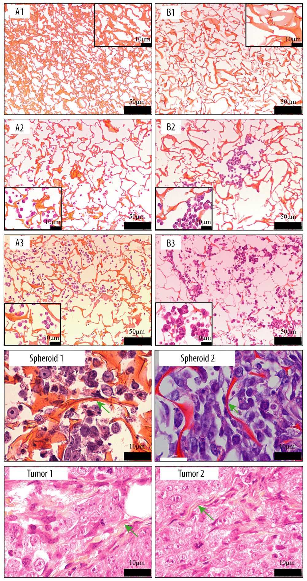 Images of hematoxylin and eosin staining of scaffold. Silk fibroin (SF)/chitosan (Cs) (1: 1) scaffold without cells (A1), SF/Cs/alginate (Alg) (1: 1: 1) scaffold without cells (B1), SF/Cs (1: 1) scaffold with cells on day 3 (A2), SF/Cs/Alg (1: 1: 1) scaffold with cells on day 3 (B2), SF/Cs (1: 1) scaffold with cells on day 7 (A3), SF/Cs/Alg (1: 1: 1) scaffold with cells on day 7 (B3). Spheroids formed in the SF/Cs (1: 1) scaffold are observed under oil lens of Leica DM2500 (spheroid 1). Spheroids formed in the SF/Cs/Alg (1: 1: 1) scaffold are observed under oil lens of Leica DM2500 (spheroid 2). Tumor formed subcutaneously in nude mice after inoculation with HCT-116 cells, observed under oil lens of Leica DM2500 (tumor 1, 2). Green arrows indicate the fiber band.