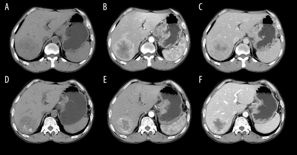 A 54-year-old male with liver metastasis of gastric cancer. Computed tomography (CT) was performed before (A–C) and 1 month after (D–F) c-TACE (conventional transarterial chemoembolization). Partial response (PR) is evaluated according to the mRECIST (E versus B; B is baseline; E is follow-up 1-month post c-TACE). The tumor necrosis was increased (F vs. C).