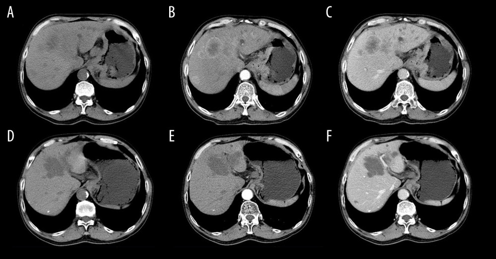 A 60-year-old male with liver metastasis of gastric cancer. Computed tomography (CT) was performed before (A–C) and 1 month after (D–F) irinotecan-eluting beads-transarterial chemoembolization (TACE). Partial response (PR) is evaluated according to the mRECIST (E versus B; B is baseline; E is follow-up 1-month post irinotecan-eluting beads-TACE). The tumor necrosis was increased (F vs. C).