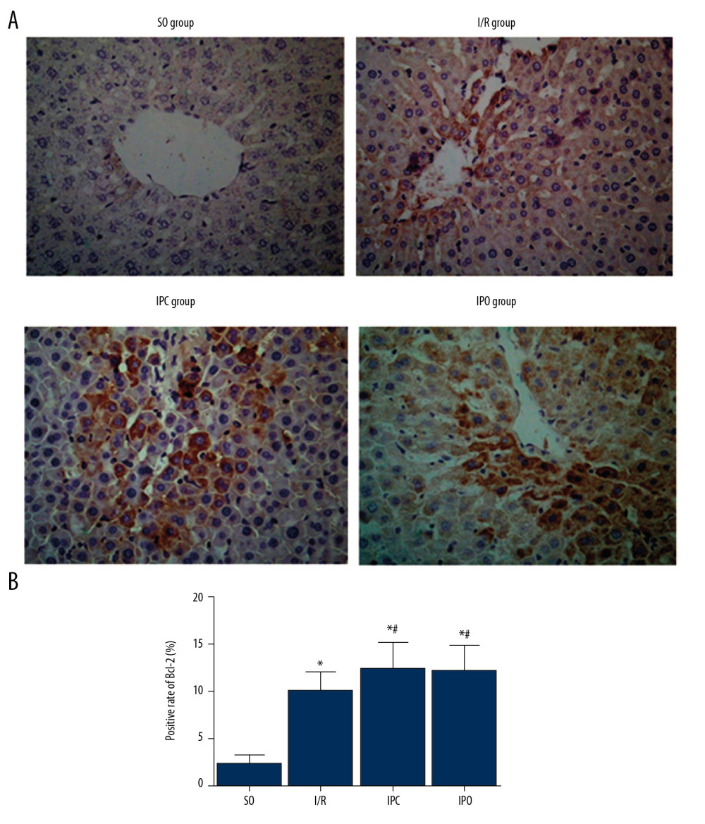 Level of Bcl-2 protein in liver tissue. Rats were divided into the SO group, I/R group, IPC group, and IPO group. Bcl-2 level was detected with immunohistochemistry. (A) Representative immunohistochemical staining results of Bcl-2 in SO group, I/R group, IPC group, and IPO group are shown. (B) Positive rate of Bcl-2. Compared with SO, * P<0.05; compared with I/R, # P<0.05.