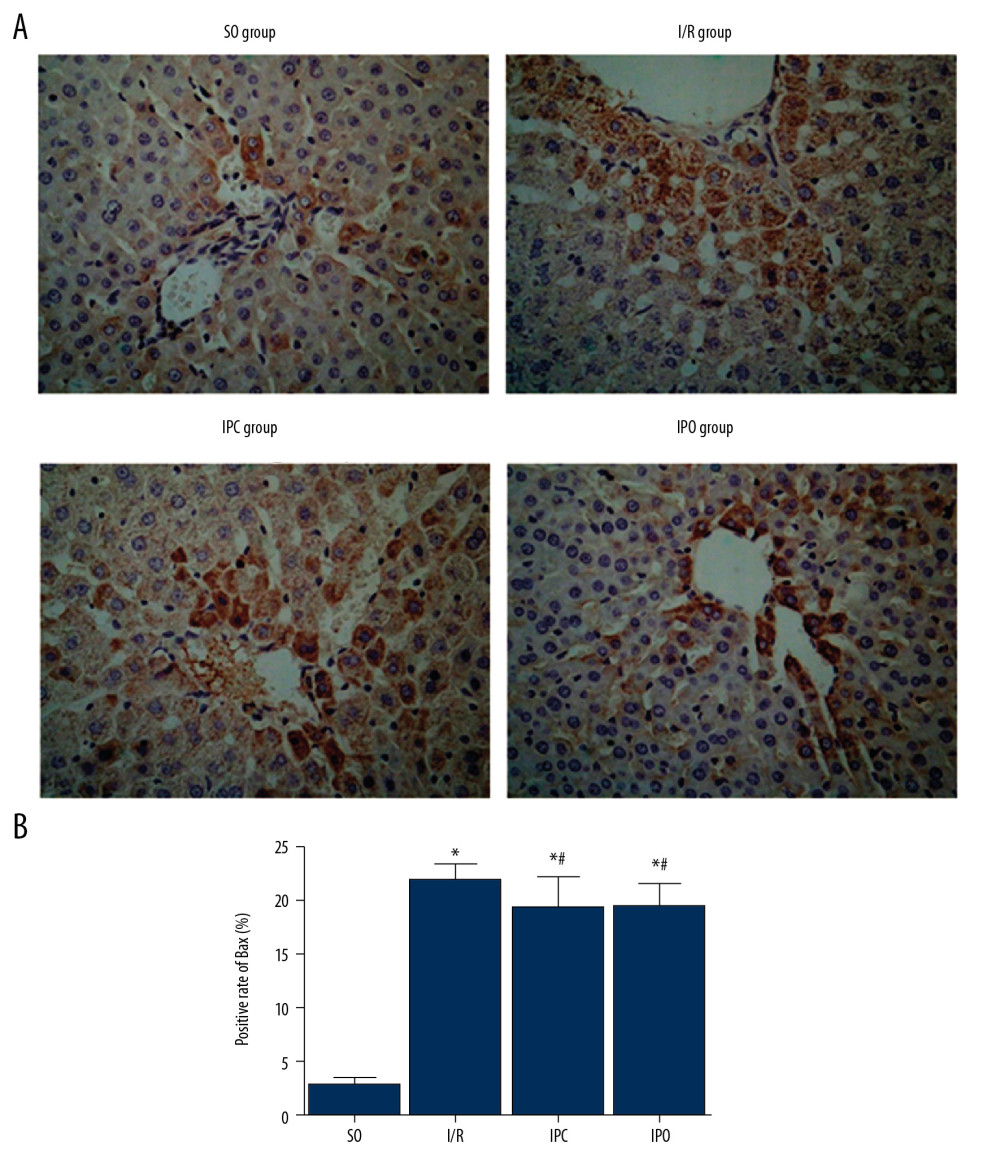 Level of Bax protein in liver tissue. Rats were divided into the SO group, I/R group, IPC group, and IPO group. Bax level was detected with immunohistochemistry. (A) Representative immunohistochemical staining results of Bax in SO group, I/R group, IPC group, and IPO group are shown. (B) Positive rate of Bax. Compared with SO, * P<0.05; compared with I/R, # P<0.05.