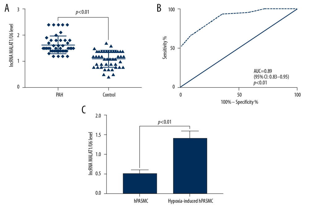 Long-chain non-coding RNA metastasis-related lung adenocarcinoma transcript 1 (lncRNA MALAT1) is highly expressed in the plasma and hypoxic human pulmonary artery smooth muscle cells (hPASMCs) of patients with PAH. (A) Quantitative reverse transcription-PCR (qRT-PCR) detection of plasma lncRNA MALAT1 levels. (B) Receiver operating curve (ROC) for the diagnosis of PAH based on plasma lncRNA MALAT1 level. (C) Comparison of lncRNA MALAT1 levels in hypoxic and non-hypoxic hPASMC cells by RT-qPCR