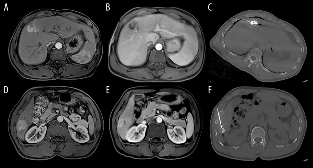 Image of the hepatocellular carcinoma before and after TACE and RFA (A, D: MRI of hepatocellular carcinoma before TACE; B, E: MRI of hepatocellular carcinoma after TACE; C, F: CT image of MRI of hepatocellular carcinoma received RFA).