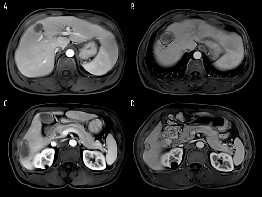 MRI of the hepatocellular carcinoma 1 months after TACE+RFA (A, C: MRI of hepatocellular carcinoma 1 moth after TACE+RFA; B, D: MRI of hepatocellular carcinoma 6 moth after TACE+RFA).