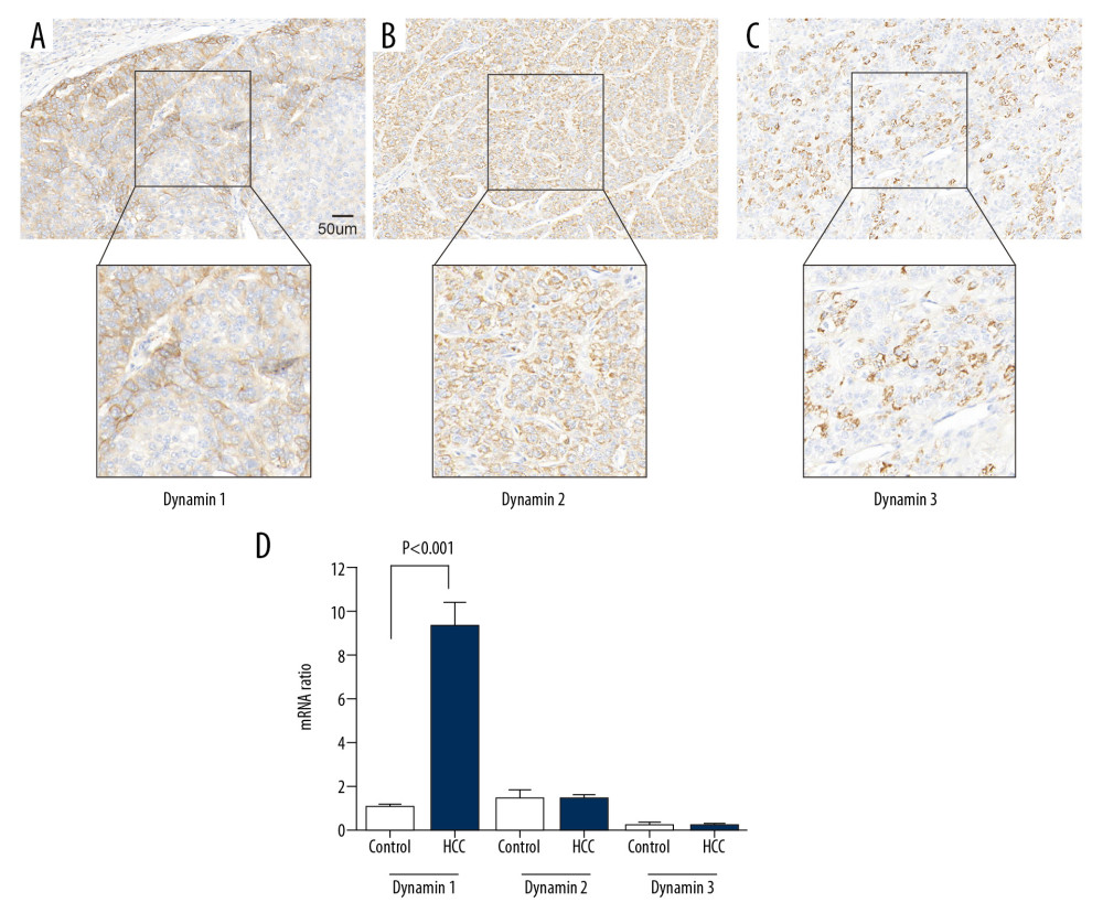 The expression of dynamin 1, 2, and 3 in tissue sections of hepatocellular carcinoma (HCC) and adjacent normal liver tissues using immunohistochemistry and quantitative real-time polymerase chain reaction (qRT-PCR). (A–C) The expression of dynamin 1, 2, and 3 detected with immunohistochemistry. Representative photomicrographs of the HCC tissue show positive immunostaining for dynamin. (D) The mRNA level of dynamin 1, 2, and 3, were detected by qRT-PCR in 14 paired tissue samples of HCC and normal adjacent liver tissue.