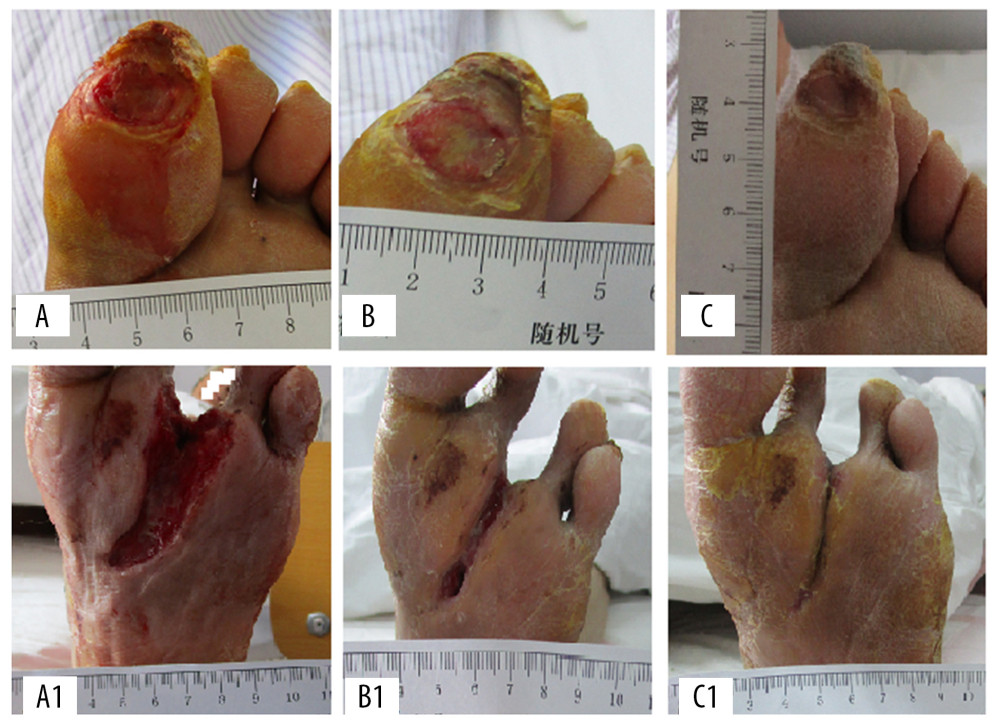 The representative cases before, during, and after CPCF and KFS treatments. (A) DFU before treatment. (B) DFU treated by KFS for 14 days. (C) DFU treated by KFS for 28 days. (A1) DFU before treatment. (B1) DFU treated by CPCF for 14 days. (C1) DFU treated by CPCF for 28 days.