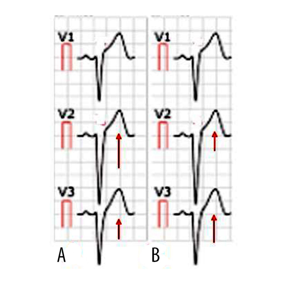 Electrocardiogram. (A) Electrocardiogram of male patient aged 45 years. (B) Electrocardiogram of female patient aged 44 years. The red arrow indicates elevation in ST-segment.